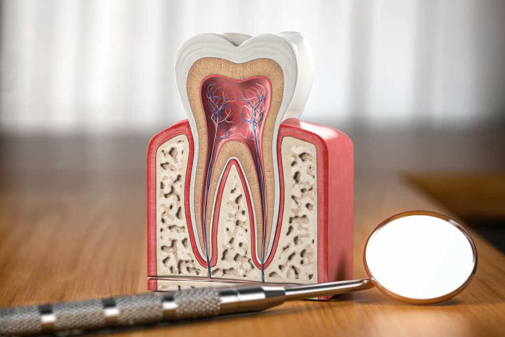 Educational tooth model illustrating a comfortable, pain-relieving root canal treatment at Newpark Dentistry in Park City.