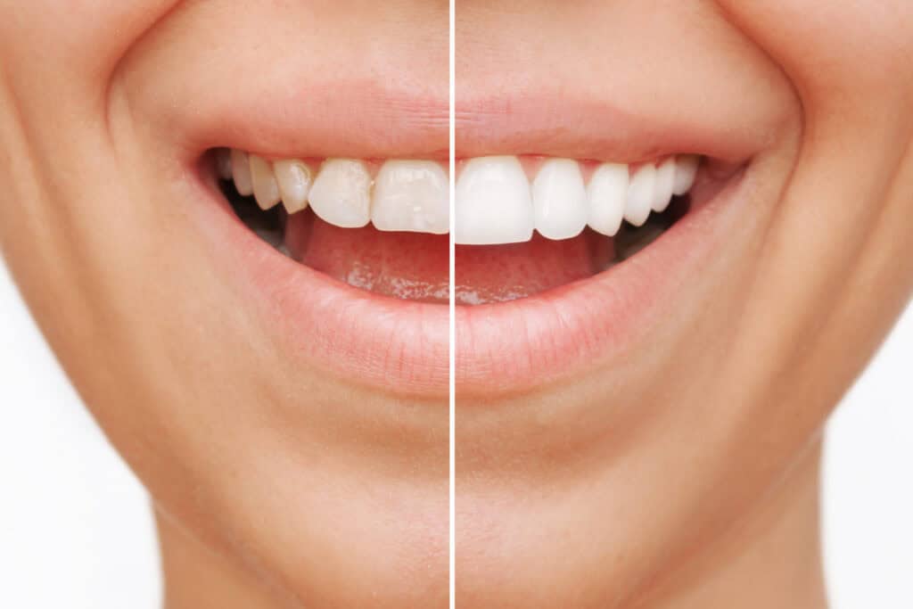 Close-up smile transformed with porcelain dental veneers and cosmetic crowns.