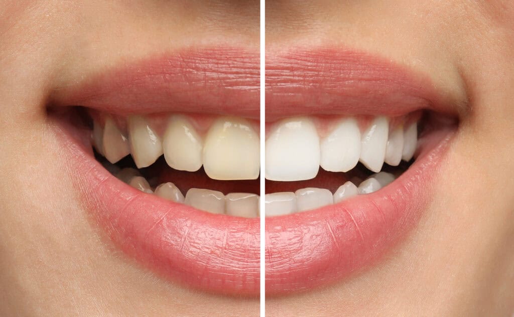 Bright results shown from professional in-office and take-home teeth whitening treatments.