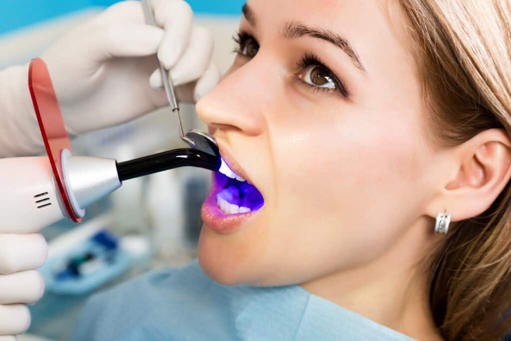 Repairing a cavity using natural tooth-colored composite dental fillings.